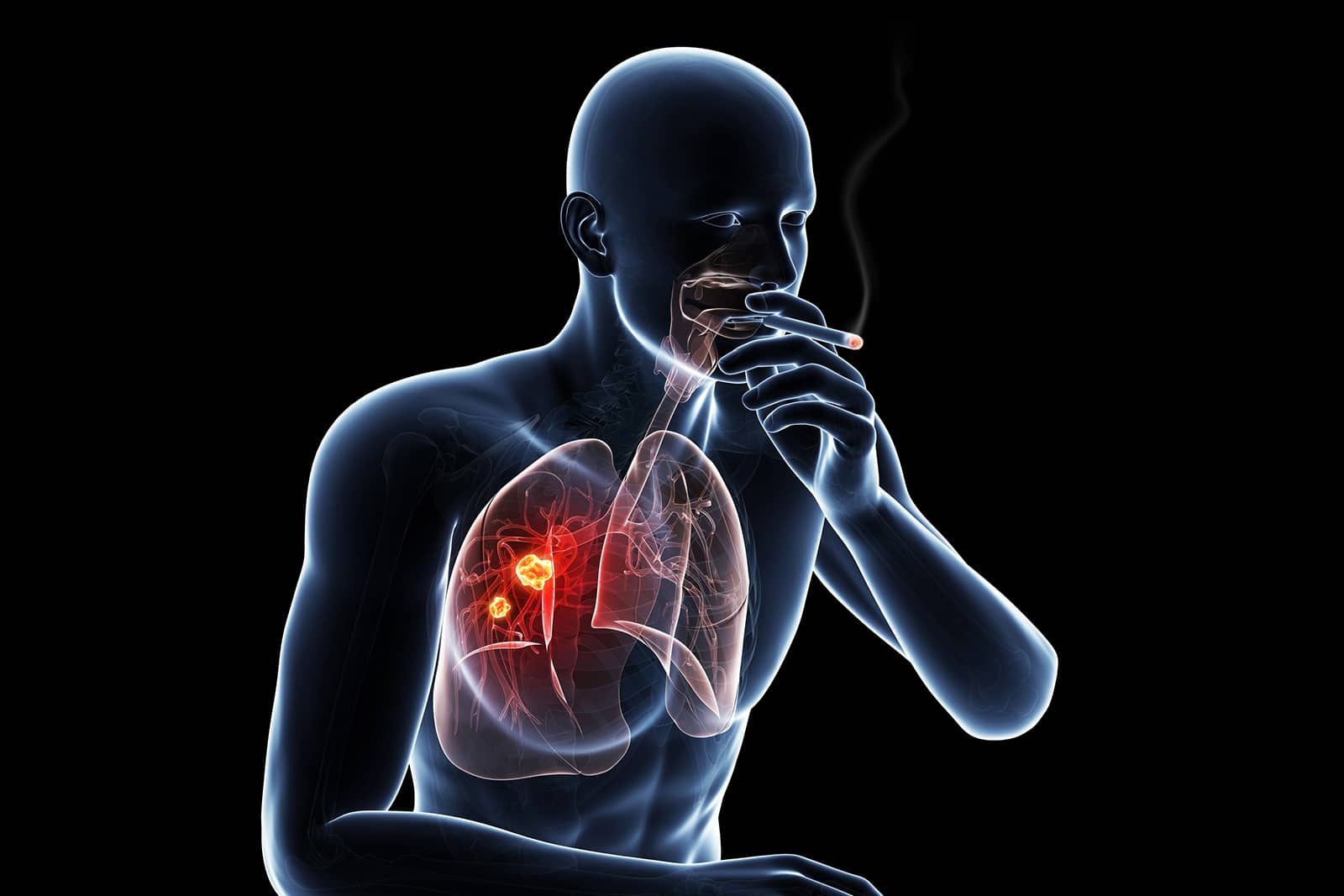چگونه سیگار خطر ابتلا به سرطان ریه را افزایش می دهد؟