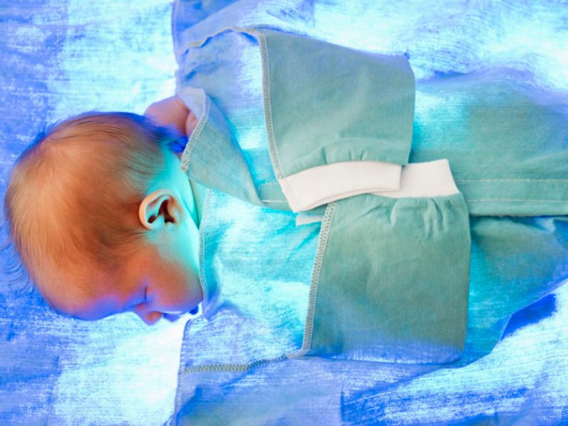 نکات مهم در خصوص افزایش سرعت بهبودی دستگاه زردی نوزاد