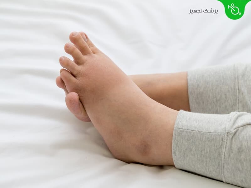 علت تورم پاها؛ مچ پاها و ساق پاها چیست؟